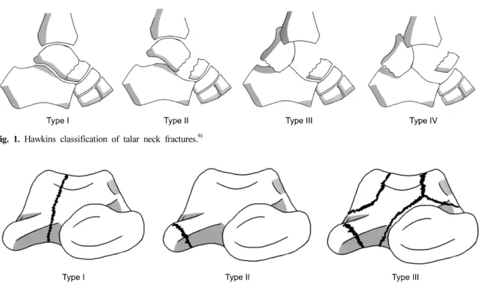 Fig. 2. Classification  of  talar  body  fractures. 11) Fig. 1. Hawkins  classification  of  talar  neck  fractures