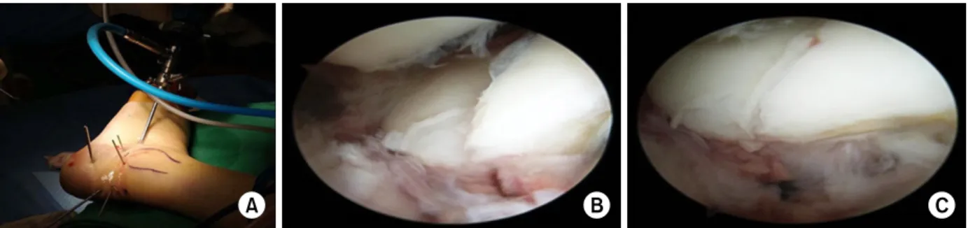 Fig. 1. (A) Arthroscopically guided reduction of the calcaneus fracture. Arthroscopic procedures are performed using the  anterolateral and central portals