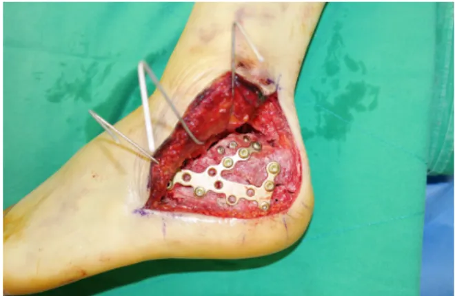 Fig. 2. Whole subtalar joint is exposed using the extensile  lateral approach.