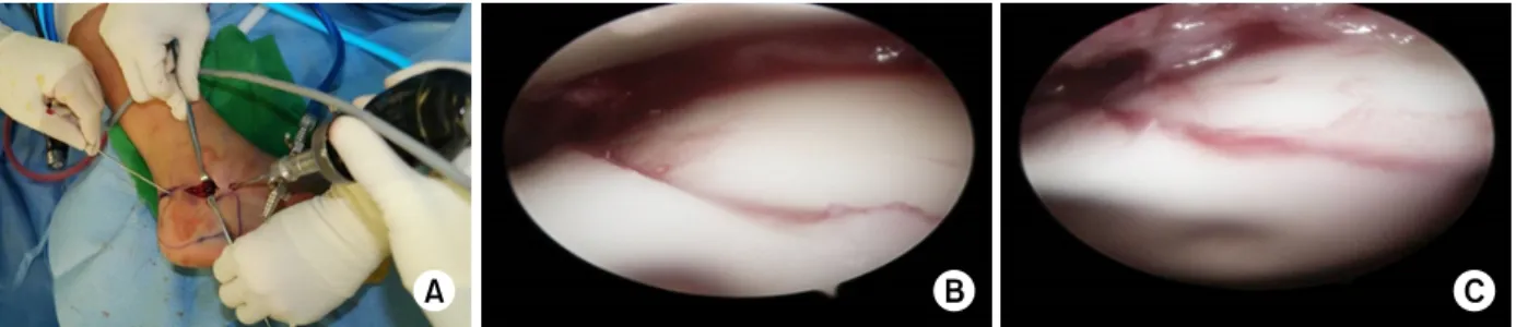 Fig. 5. (A) Open subtalar arthroscopy is performed after reduction and temporary K-wire fixation of the fragments using a  sinus tarsi approach