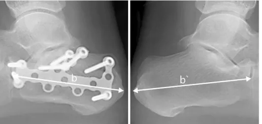 Fig. 2. The  degree  of  lateral  displacement  of  the  posterior  tuberosity  fragment  (a)  is  measured  as  the  gap  between  the  superomedial  fragment  and  posterior  tuberosity  fragment  on  the  medial  aspect  of  the  calcaneal  axial  view.