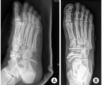 Fig. 3. (A)  Type  II  navicular  fracture  and  medial  cuneiform  subluxation  were  seen  on  an  oblique  radiograph