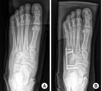 Fig. 5. Medial  cuneiform  frac- frac-ture  with  Lisfranc  injury  was  seen  on  simple  radiograph  and computed  tomography.