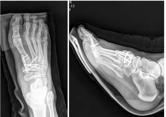 Fig. 6. Fracture  of  the  me- me-dial  cuneiform  and  Lisfranc  joint  were  reduced  and   fix-ated  with  plate  and  screws.