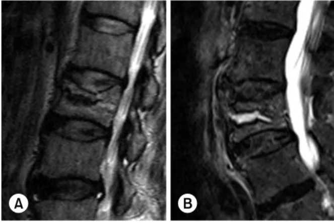 Fig. 1. Sagittal thoracic vertebra (T2)-weigted magnetic  resonance imaging showing (A) the intervertebral cleft with  surrounding bone edema signal intensity, (B) high signal  lesion (fluid collection).