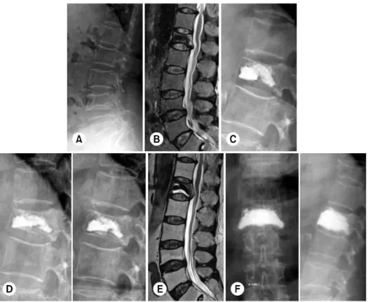 Fig. 2. A 65-year-old female  with lumbar vertebra (L1)  osteo-porotic vertebral compression  fracture (dual energy x-ray  absorptiometry T-score: −4.4)