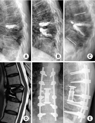 Fig. 3. A 60-year-old male with thoracic vertebra (T8, 9) osteo- osteo-porotic vertebral compression fracture (dual energy x-ray  ab-sorptiometry T-score: −3.2)