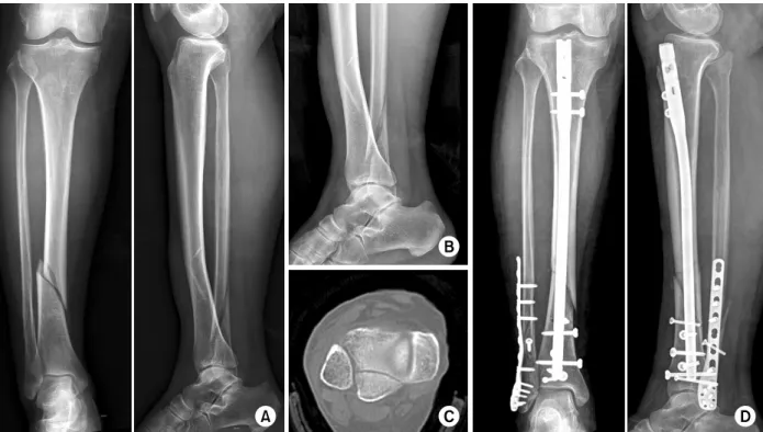 Fig. 1.  (A) Initial tibia anteroposterior (AP) and lateral image of a 63-year-old female showing a spiral fracture at the distal  third of the tibia shaft