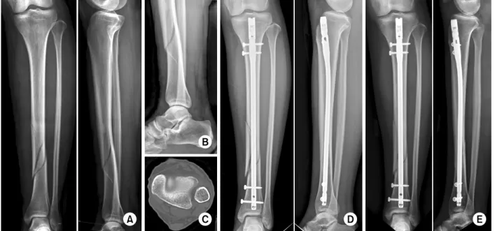 Fig. 2.  (A) Initial tibia anteroposterior (AP) and lateral image of a 41-year-old female showing a spiral fracture at the distal  third of the tibia shaft