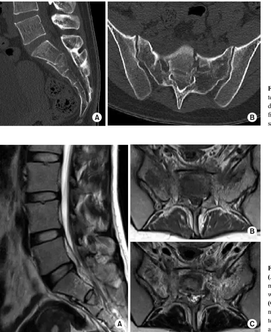 Fig. 1. (A, B) Initial compu- compu-ted tomography scan shows a  displaced comminuted sacral  fracture with narrowing of the  sacral canal at the S1-S2 level.