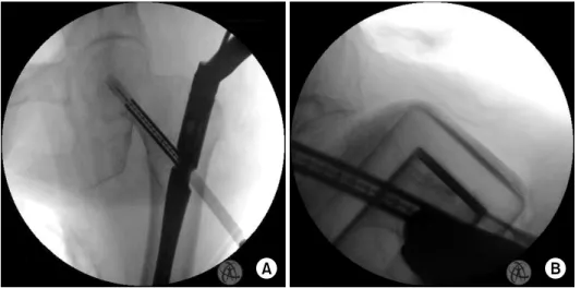 Fig. 7. (A) Use of the sure- sure-shot guide to help determine  proper nail positioning was  shown under fluoroscopy