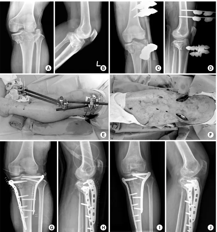 Fig. 13. Schatzker type V fracture was initially managed with temporary external fixation (A-E) and treated with a  submeniscal approach and dual plating method using a locking compression plate (LCP) on the lateral side and LCP T-plate  on the medial side