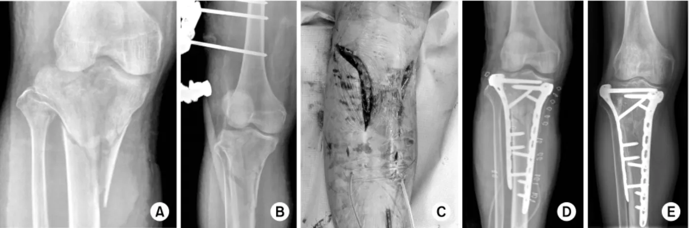 Fig. 14. (A-D) Schatzker type VI open fracture with posterior hip dislocation was treated with internal fixation using locking  compression plate (LCP) on the lateral side and LCP T-plate on the medial side after temporary maintenance of the limb  length a