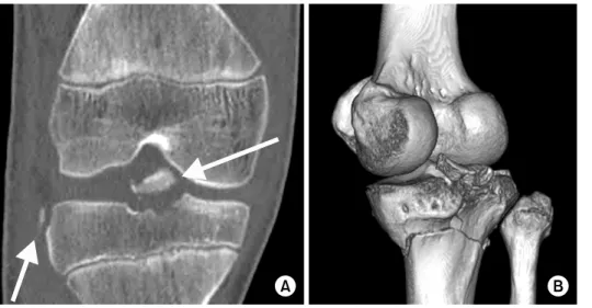 Fig. 2. (A) Associated ante- ante-rior cruciate ligament injury  with Segond’s fracture  (arr-ows)