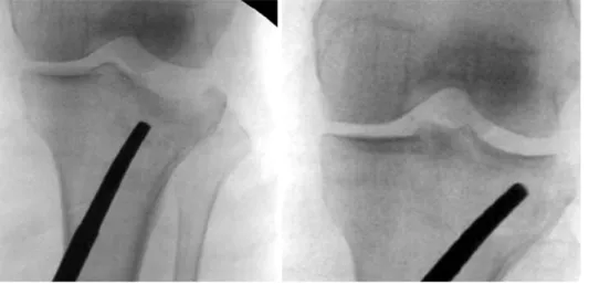 Fig. 4. Depressed fracture of  the lateral tibial plateau was  reduced using an impactor  under fluoroscopic guidance