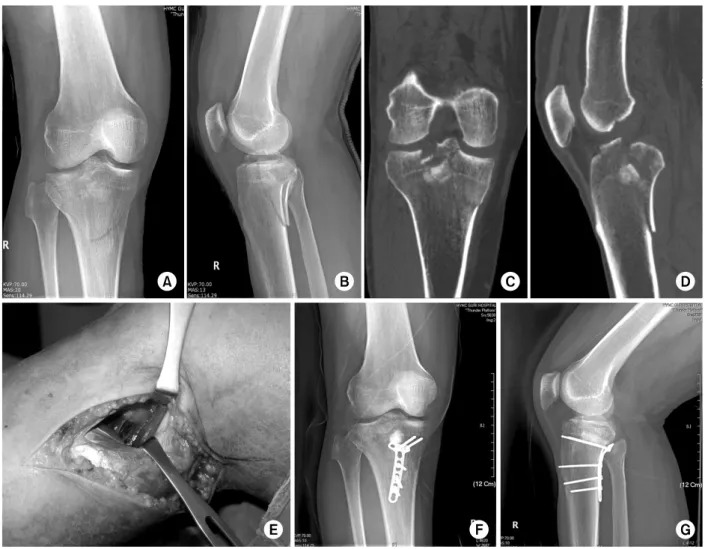 Fig. 6. (A, B) Plain radiographs show a complex tibial plateau fracture. (C, D) Computed tomography images indicating that  both the lateral and posteromedial column are involved