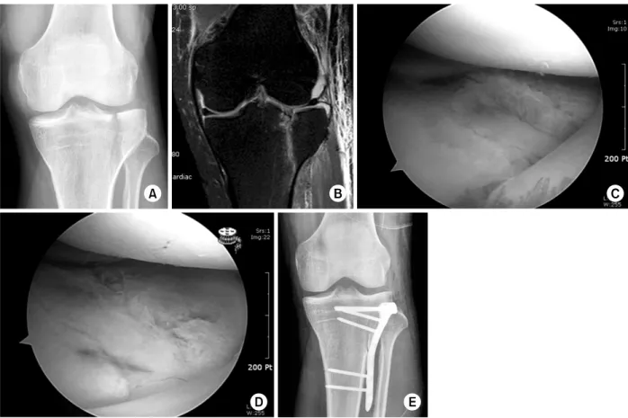Fig. 8. (A, B) Plain radiograph and magnetic resonance image show a Schatzker type I fracture