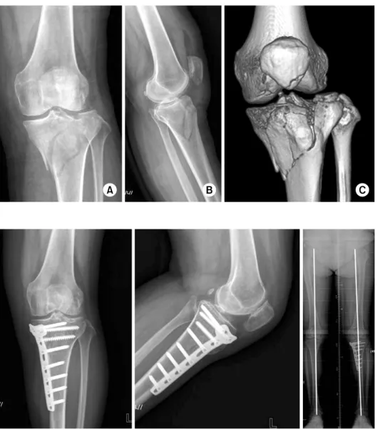 Fig. 10. (A, B) Plain radio- radio-graphs show. (C) The  3-di-mensional computed  tomogra-phy scan shows fracture  geo-metry in the lateral tibial  plateau, which divides  ante-rior and posteante-rior fragment.