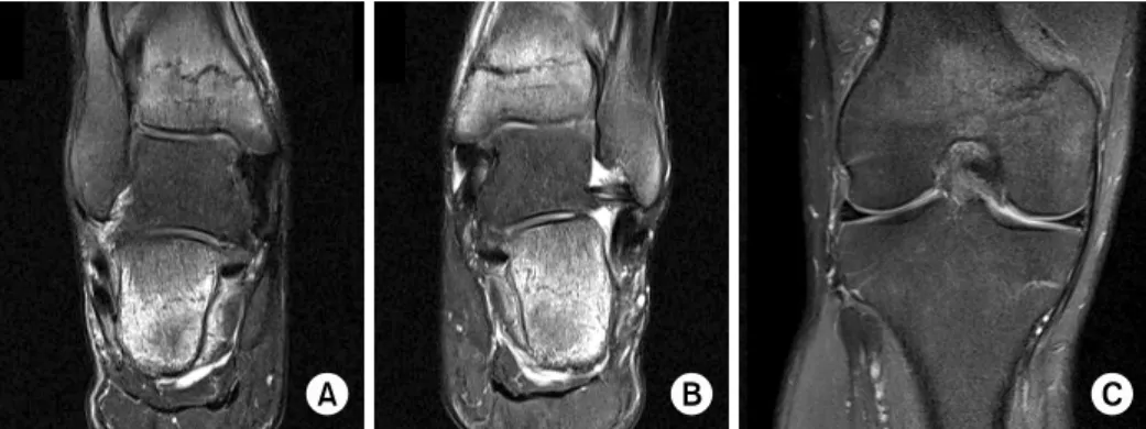 Fig. 1. Magnetic resonance image showed diffuse high signal intensity at the right distal tibia and talus (A), left distal tibia  and talus (B), and distal femur and proximal tibia (C) on coronal T2-weighted images.