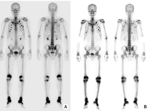 Fig. 2. (A) Whole body bone  scan taken at the initial visit  showed multiple hot uptakes  at multiple ribs, right  sacro-iliac joint, both distal femurs  and proximal tibias, and both  distal tibias and tali