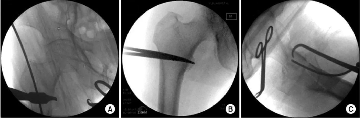 Fig. 1. Reduction technique. 