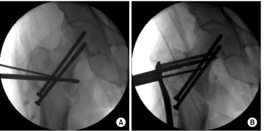 Fig. 3.  (A) A bone hook was  maintained in place until the  lag screws were inserted at  the proper position of the  femoral head