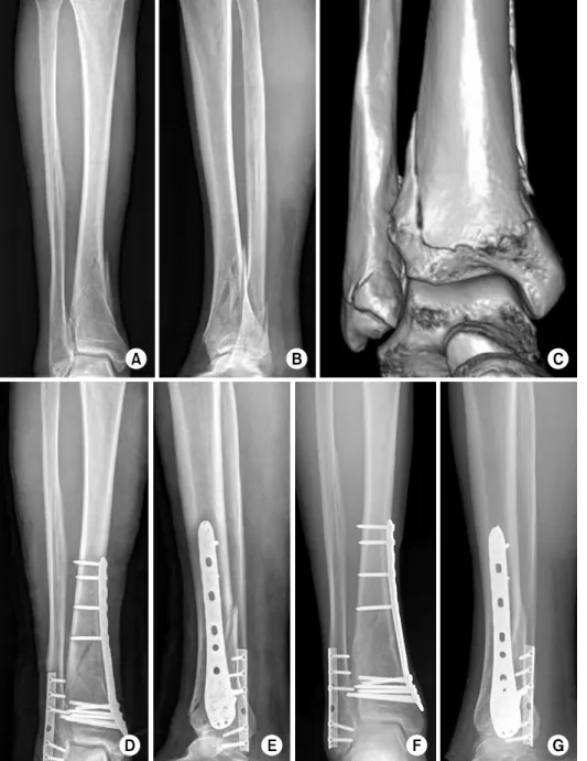 Fig. 1. (A-C) Preoperative  radiographs and 3-dimensional  computed tomography of a 53  year-old man shows a distal  tibia and fibular fractures  cla-ssified as the AO/OTA type  43-B1.