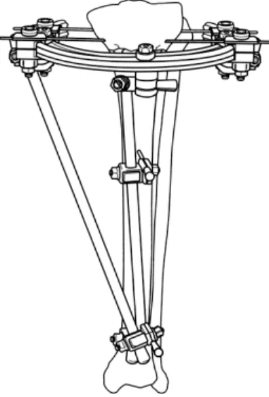 Fig. 1. Proximal tibia fracture fixed with hybrid external  fixator. 3.  프레임     단순한  rod형과,  관절이  있는  것(articulated),  연장이  가능한  형태(telescopic)가  존재하며  재질로는  금속제와  방사선  투과가  가능한  탄소  재질로  크게  나눌  수  있다