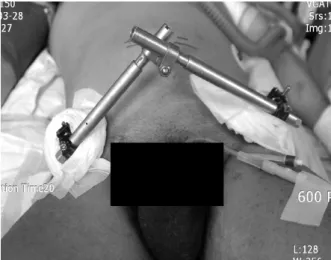 Fig. 2. Pelvic external fixation for hemodynamically unstable  pelvic ring injury.