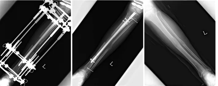 Fig. 3. Tibial lengthening over the nail with Ilizarov device.
