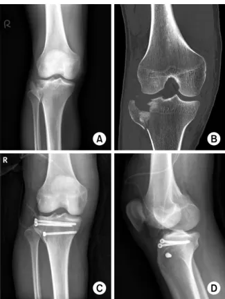 Fig. 4. Preoperative radiologic findings. Antero-posterior (AP)  view  (A) and computed tomography (CT) image (B) of the  left knee of a 60-year-old male patient shows a tibia plateau  fracture (Schatzker type V)