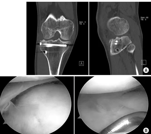 Fig. 5. (A) Ten months after  the operation, computed  tomo-graphy images show a  comp-lete bone union with  cong-ruency of the articular surface