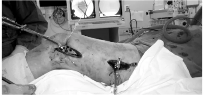 Fig. 1. Indirect reduction and temporary plate fixation with  reduction forceps and K-wires.