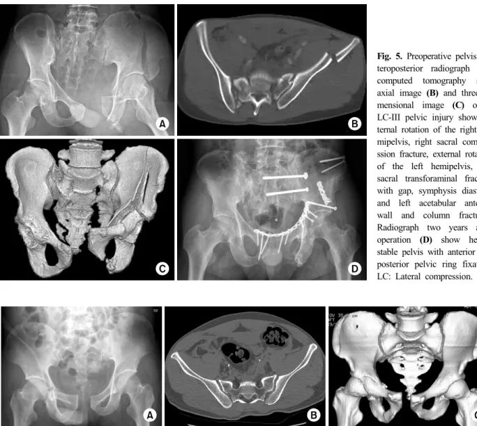Fig. 5. Preoperative pelvis an- an-teroposterior radiograph (A),  computed tomography scan  axial image (B) and  three-di-mensional image (C)  of a  LC-III pelvic injury show  in-ternal rotation of the right  he-mipelvis, right sacral  compre-ssion fractur