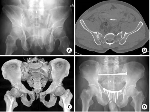 Fig. 7. Preoperative pelvis ou- ou-tlet radiograph (A), computed  tomography scan axial image  (B) and three-dimensional  im-age  (C)  of an APC-II pelvic  injury show diastasis of  sym-physis with opening of the  left anterior SI joint, but intact gap of 