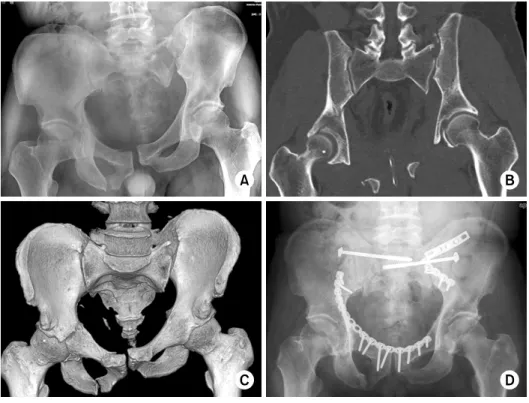 Fig. 9. Preoperative pelvis an- an-teroposterior radiograph (A), computed tomography scan  coronal image (B) and three-  dimensional image (C) of a  VS type pelvic injury show  cephalic displacement of the  left hemipelvis with avulsion  fracture of the fi