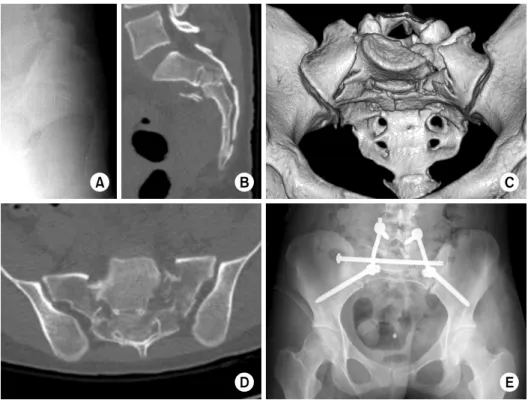 Fig. 11. Preoperative sacrum  lateral radiograph (A) shows  nonspecific findings, but the  computed tomography (CT)  scan coronal image (B)  shows  S2 transverse and compression  fracture with mild flexion  de-formity