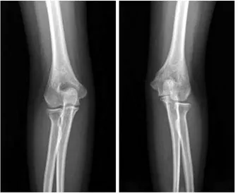 Fig. 5. Anteroposterior radiographs of both elbows taken 4  years after surgery (when the patient was 7 years old)  showed deformity of the distal humerus in the left elbow.
