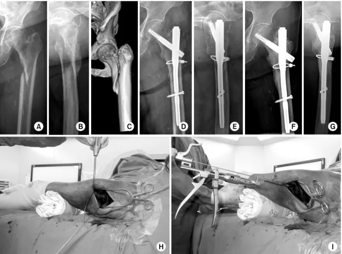 Fig. 2.  (A-C) Initial hip Anteroposterior view, hip joint lateral and pelvis computed tomography images show a spiral  subtrochanteric fracture of the femur with a large fragment