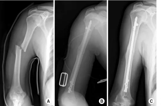 Fig. 2.  (A) Initial radiographs  show a short oblique fracture  of the humeral shaft area