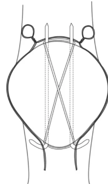 Fig. 1. A cerclage wire is prepared for the anti-gliding loops  with proximal two knots like a Mickey Mouse hat.