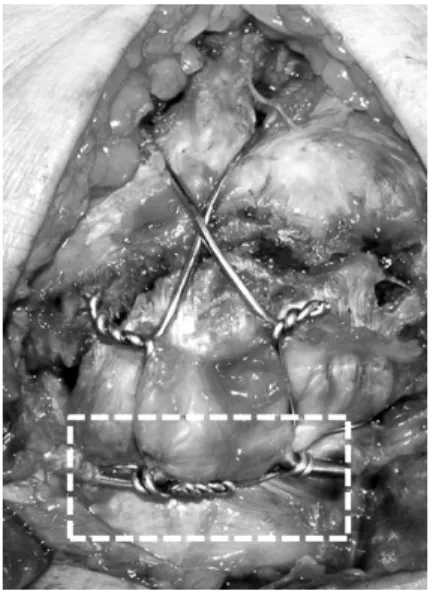 Fig. 5. Fluoroscopic image of modified tension band fixation  and the tightened cerclage wire with anti-gliding loops.