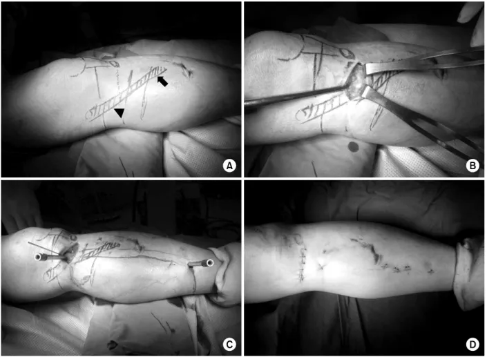 Fig. 1. Operative procedure.