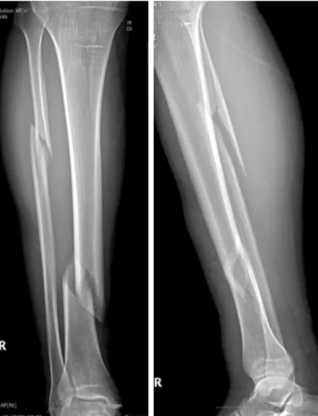 Fig. 3. We successfully pulled out the broken reamer using  a guidewire in a retrograde manner through the additional  incision over the fracture site.