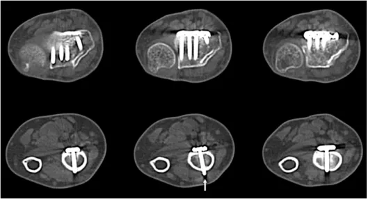 Fig. 1. Postoperative plain radiographs show that the proxi- proxi-mal screw tips of fixed volar plate are protruded about 1-2  mm from the dorsal cortex of distal radius