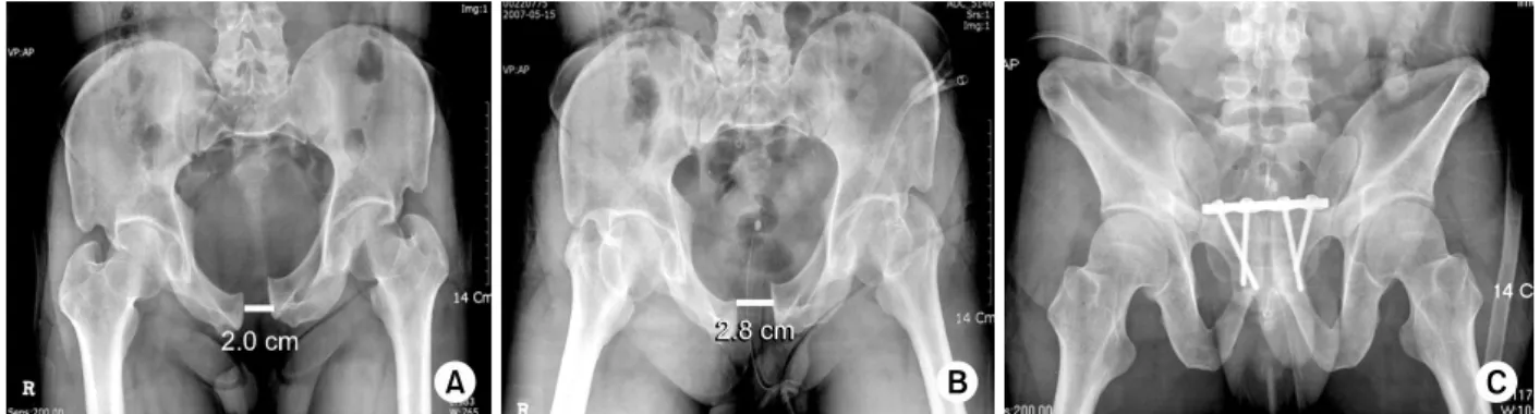 Fig. 1. A 42-year-old man sustained a type B pelvic bone fracture with symphysis pubis dislocation