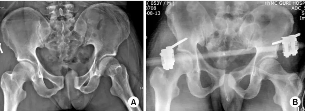 Fig. 2.  (A) A 53-year-old man sustained a type B pelvic  bone fracture with open  wou-nd in the inguinal area.