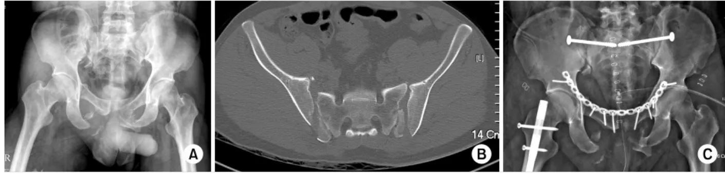 Fig. 3.  (A) Pelvis anteroposterior radiograph and (B) axial computed tomography scan demonstrating both small superior  crescent fractures.