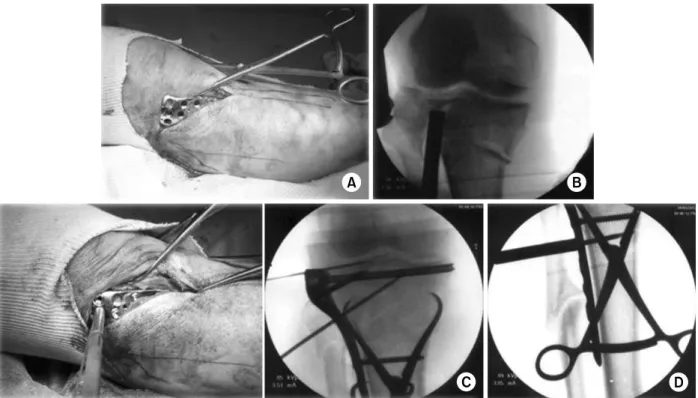 Fig. 1.  (A) As a surgical method, we used a lateral submeniscal approach to make a precise reduction of the articular surface
