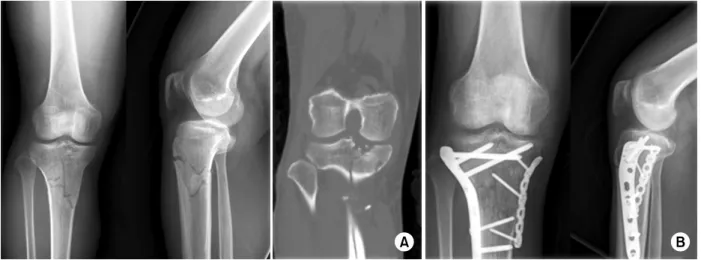 Fig. 2. A 46-year-old man with Shatzker type VI (road traffic accident). 